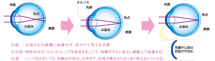 左図:近視のため網膜に結像せず、ぼやけて見える状態。中央図:特殊形状の「オルソK」レンズを装用することで、角膜が平らに変化し網膜上で結像するため、近視が減り見えるようになる。