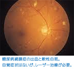 糖尿病網膜症